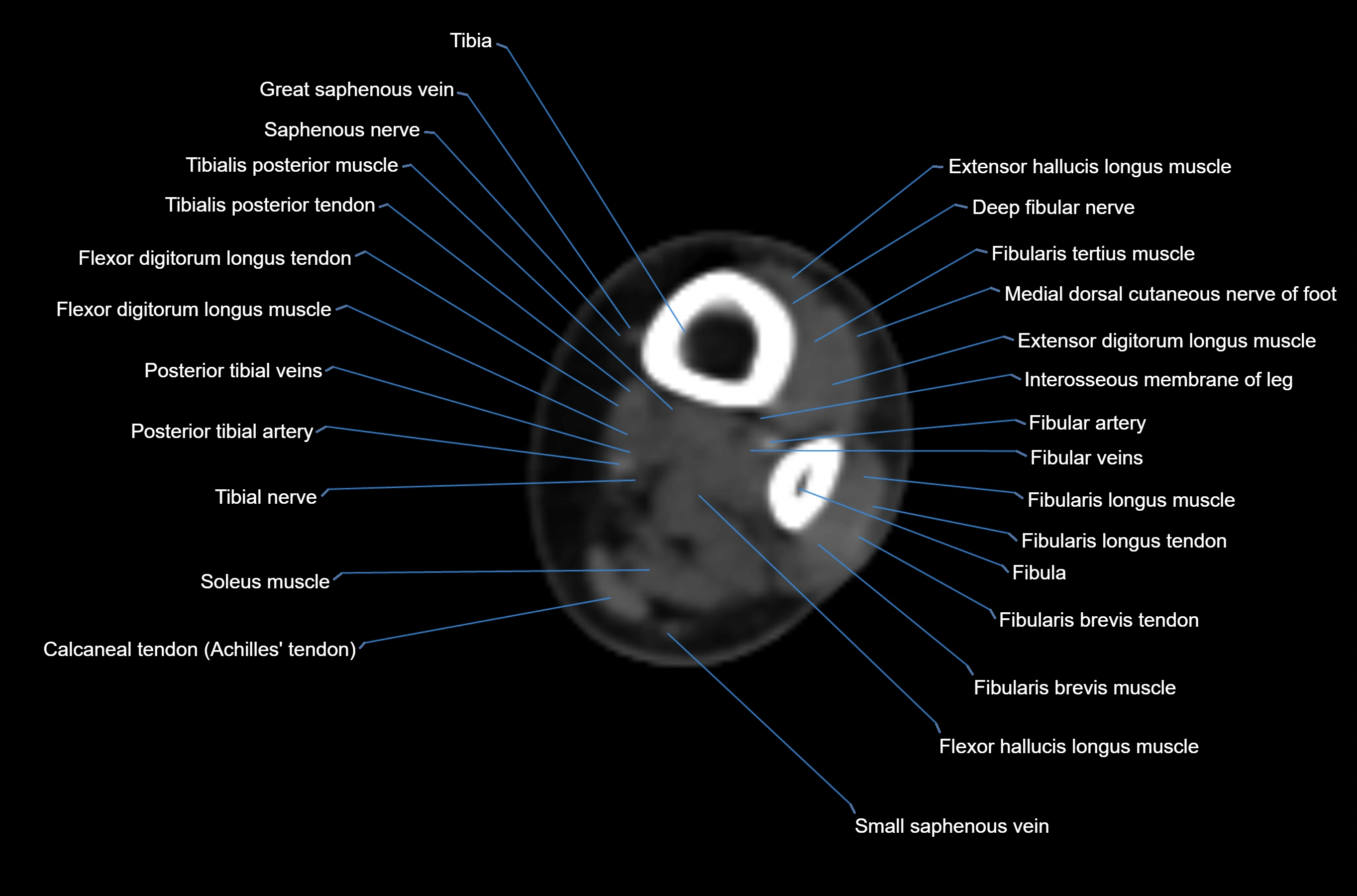 CT Ankle axial cross sectional anatomy labelled image -00006.webp